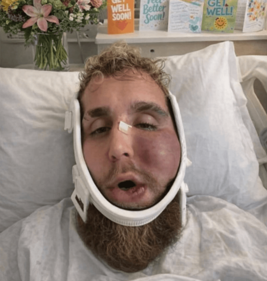Jake Paul face beaten up