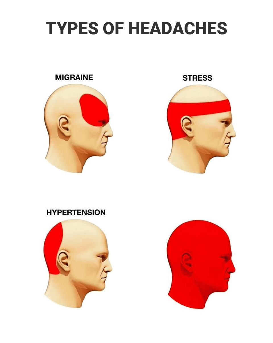 Types of headaches diagram